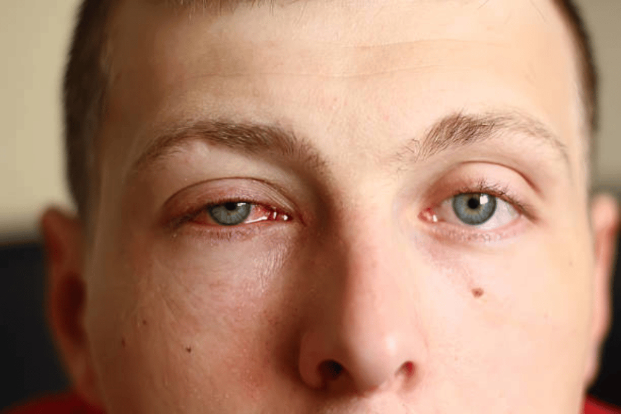 Nếu chữa không đúng cách, bệnh đau mắt đỏ có tái phát không?
