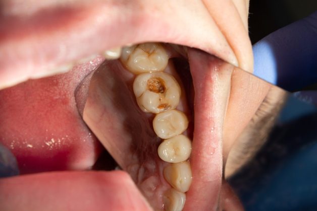 Tình trạng 3 lớp của răng bị tổn thương do acid gọi là bệnh lý sâu răng.