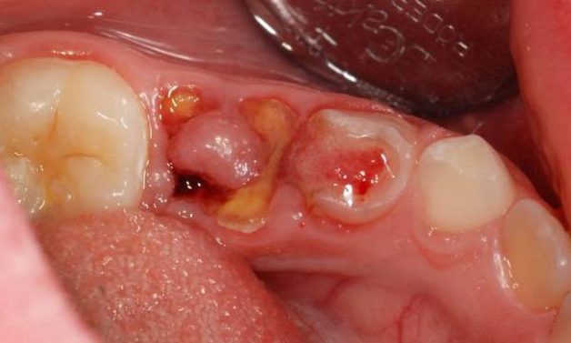 Rụng răng: Xảy ra khi toàn bộ cấu trúc nâng đỡ và hệ thống mạch máu nuôi dưỡng răng đã bị phá hủy hoàn toàn