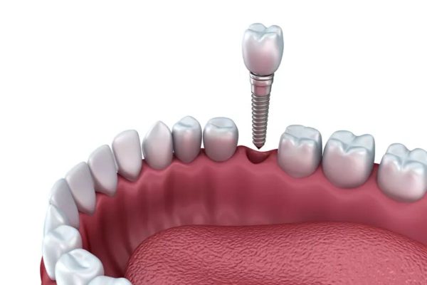 Cấy ghép Implant phục hình cho răng bị mất do nhiều nguyên nhân