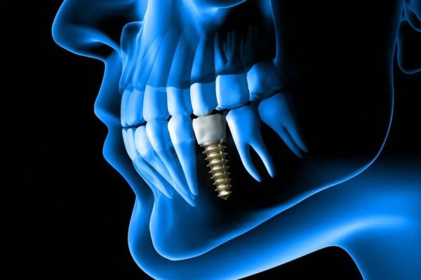 Khi nào cần cấy implant theo các bác sĩ nha khoa là trường hợp răng bị mất lâu năm, sâu răng viêm tuỷ nặng...