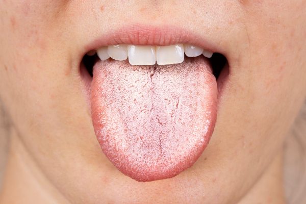 Từ hình ảnh nấm miệng, nhận biết triệu chứng để điều trị