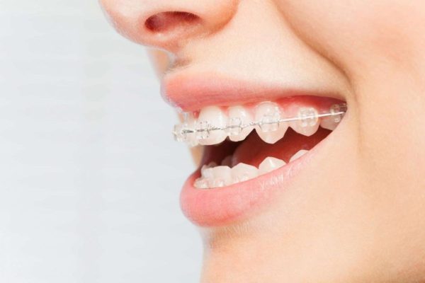 Niềng răng là phương pháp có khả năng điều chỉnh răng lệch lạc, khấp khểnh một cách hiệu quả