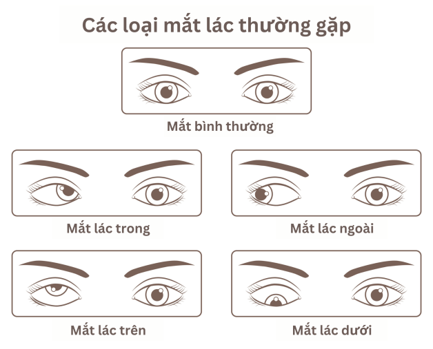 Mắt Lác Nhẹ: Nguyên Nhân, Triệu Chứng và Cách Điều Trị Hiệu Quả