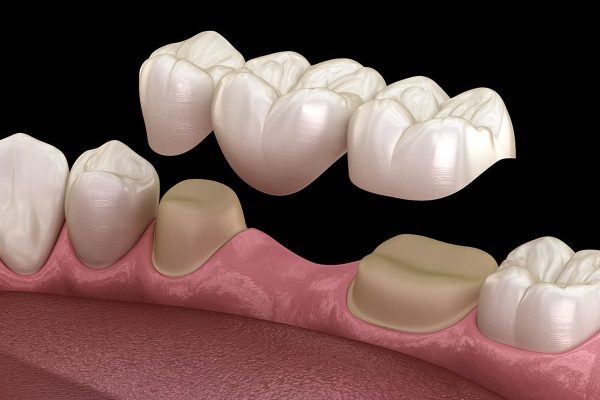Làm cầu răng sứ để phục hình cho các răng bị gãy rụng