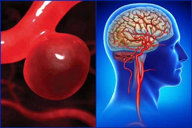 phình mạch não là nguyên nhân gây tai biến mạch máu não