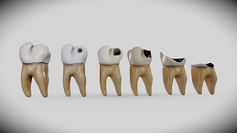 5 loại răng sâu phổ biến và cách điều trị