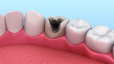 Sâu răng là gì? Nguyên nhân, triệu chứng, cách điều trị