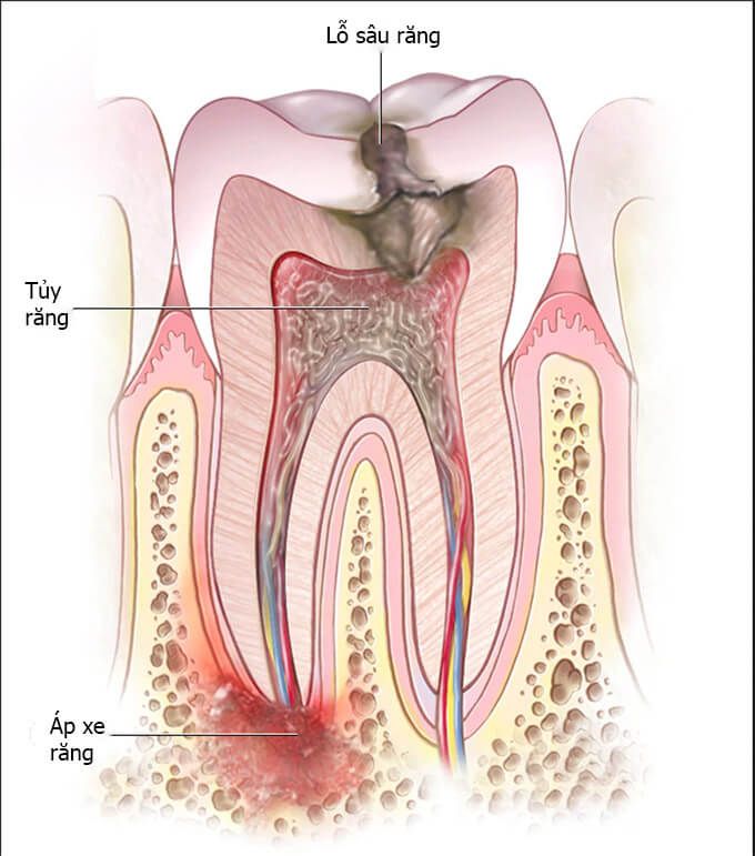 sâu răng nặng