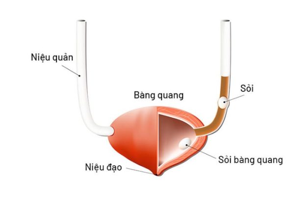 sieu am chan doan soi bang quang e1666774918427