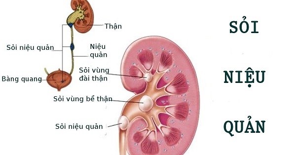 soi nieu quan.2 2