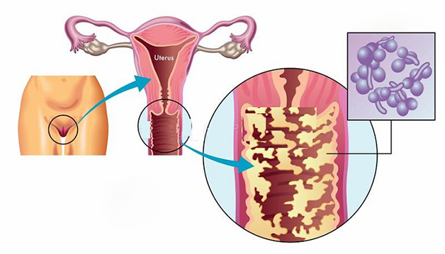 Viêm vùng kín là biểu hiện viêm, tổn thương tại các cơ quan sinh dục ngoài như âm đạo, âm hộ