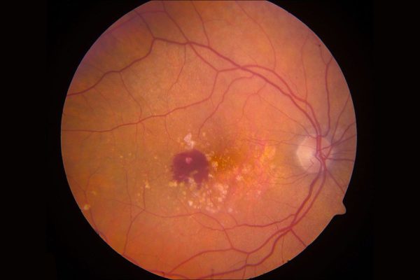 Thoái hóa võng mạc (Retinal Degeneration) là quá trình lão hóa và suy thoái lớp tế bào võng mạc mắt