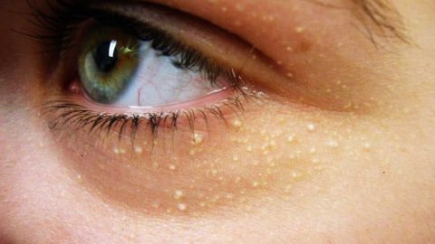 U mỡ vàng mi mắt: Mọi điều bạn cần biết
