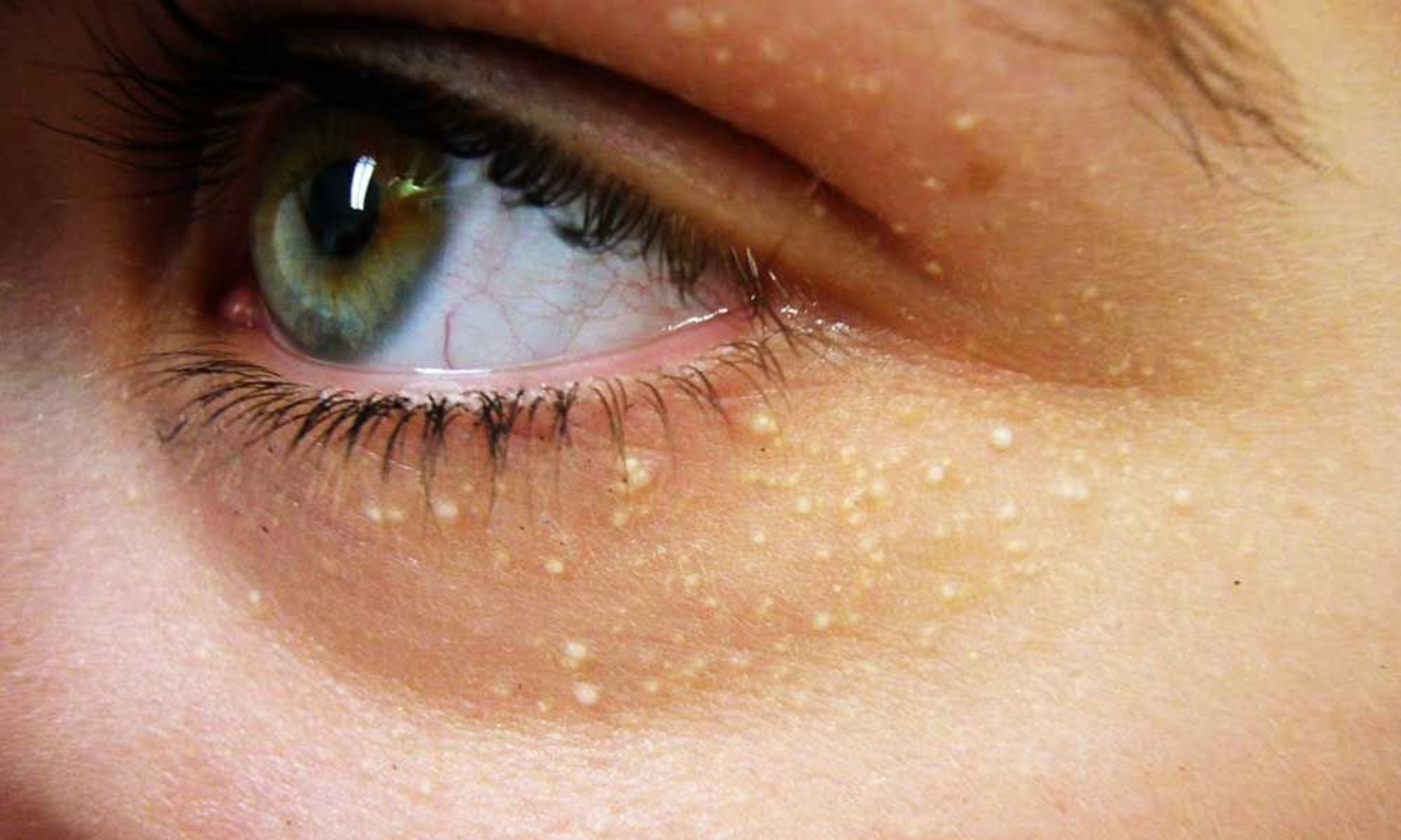 U mỡ vàng ở mắt có nguy hiểm không?
