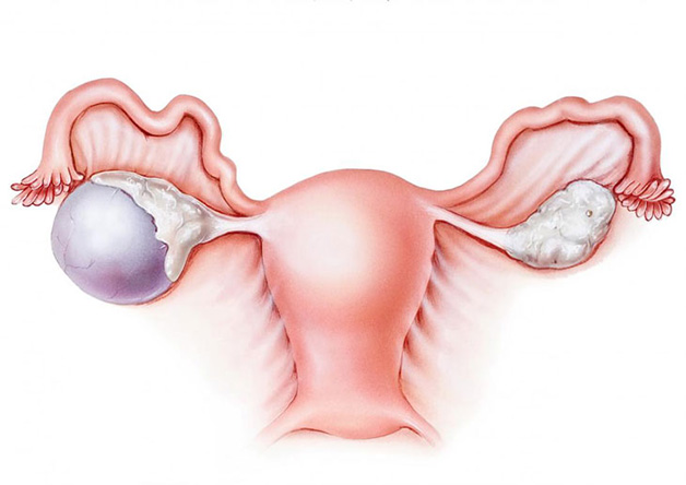 U nang buồng trứng là khối u gây ảnh hưởng đến hoạt động của buồng trứng, có thể xuất hiện ở một hoặc cả hai bên buồng trứng