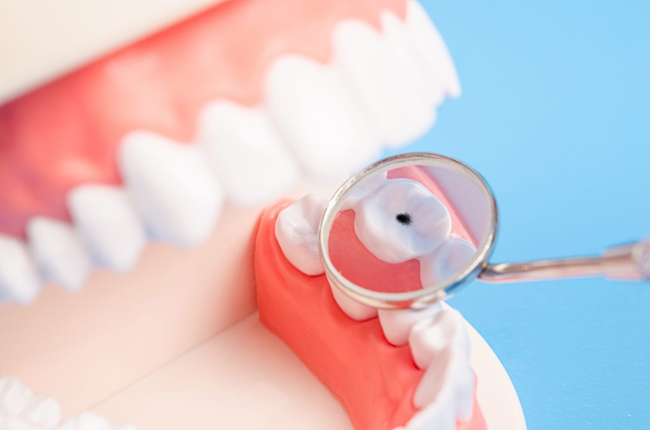 Tác động của vi khuẩn sâu răng lên sức khỏe răng miệng