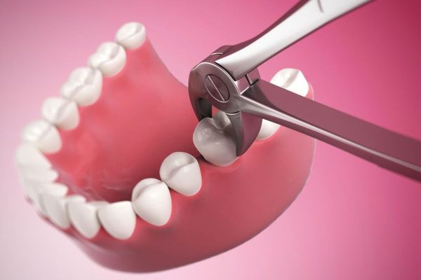 Nhổ răng tạo khoảng trống trên cung hàm cho răng khác dịch chuyển là câu trả lời cho thắc mắc vì sao niềng răng phải nhổ răng