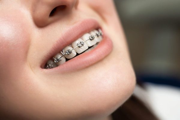 Niềng răng là kỹ thuật chỉnh nha thường được áp dụng hiện nay để khắc phục sai lệch ở răng