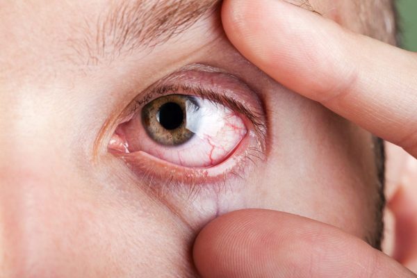 Người mắc bệnh thường gặp phải tình trạng đau nhức mắt, mỏi mắt, nhìn mờ...