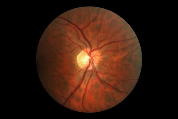 Viêm dây thần kinh thị giác là tình trạng dây thần kinh mắt bị tổn thương do nhiều nguyên nhân gây ra