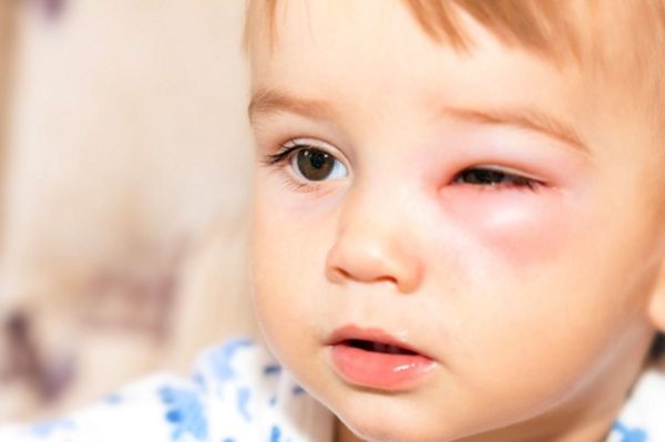 viêm kết mạc mắt trẻ sơ sinh