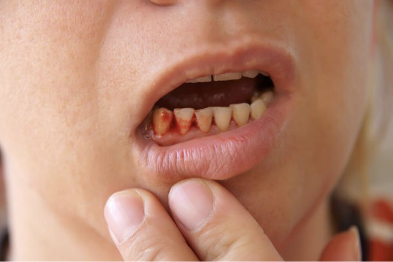 Có phải sự sưng nướu răng và chảy máu là dấu hiệu của một căn bệnh nào đó trong miệng?
