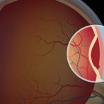 Võng mạc mắt và các bệnh lý võng mạc thường gặp