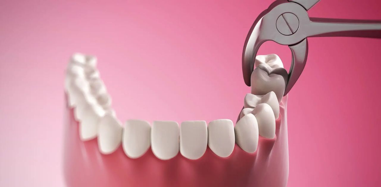 Quá trình nhổ răng khôn mọc ngang như thế nào?
