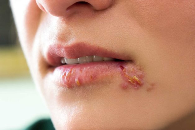 Biến Chứng Nguy Hiểm Của Bệnh Herpes