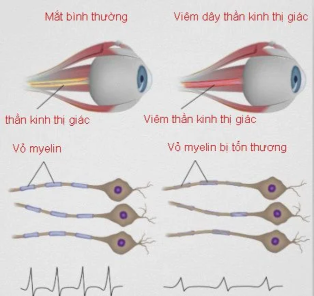 biểu hiện viêm thần kinh thị giác