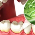 Cao răng là gì, có ảnh hưởng gì tới sức khỏe răng miệng không?