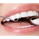 Chăm sóc răng sứ và những lưu ý không thể bỏ qua