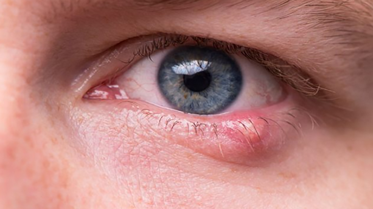 Mắt bị chắp có thể tự khỏi mà không cần điều trị?
