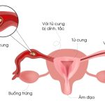 Chửa ngoài tử cung thể huyết tụ thành nang là gì?