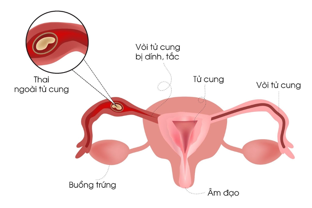 Nguyên nhân dẫn đến thai ngoài tử cung thể huyết tụ thành nang là gì? 
