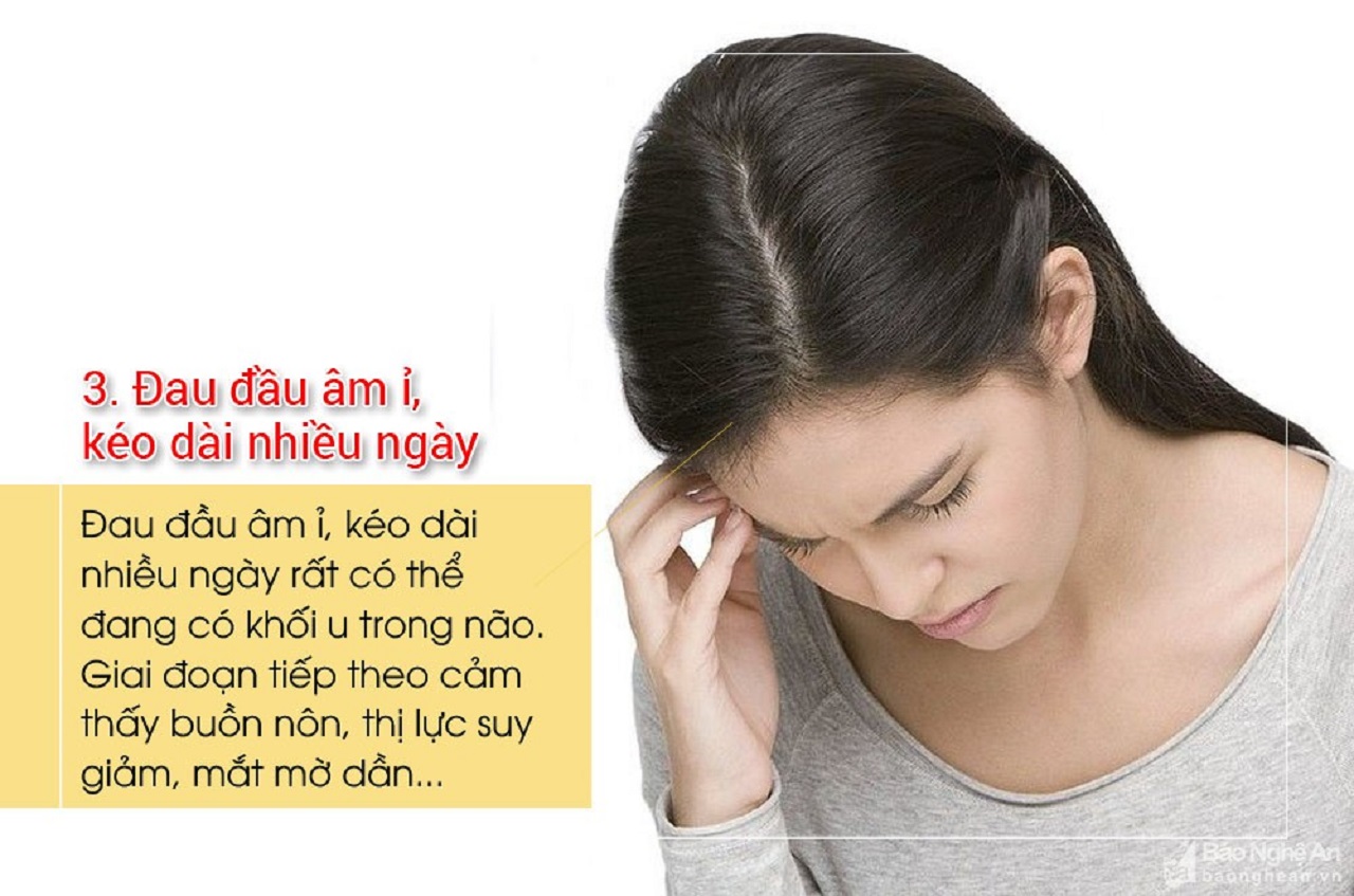 Đau đầu một bên thái dương trái có phải là triệu chứng của đau nửa đầu Migraine không?
