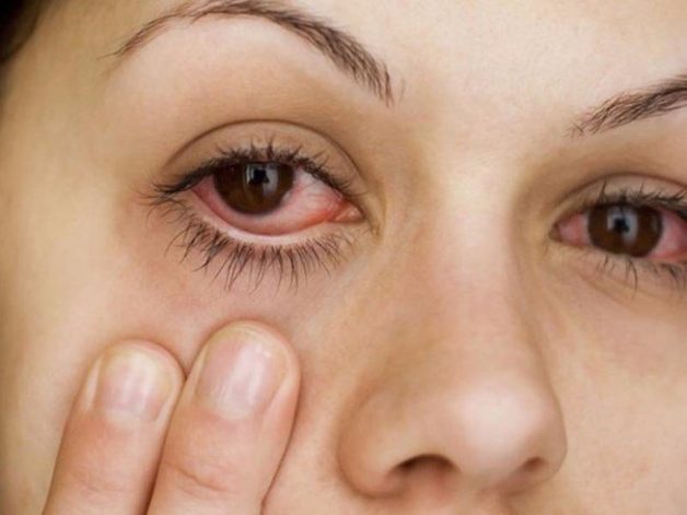 Đau mắt đỏ có thể được nhận biết thông qua việc lòng trắng và mí mắt đỏ và sưng