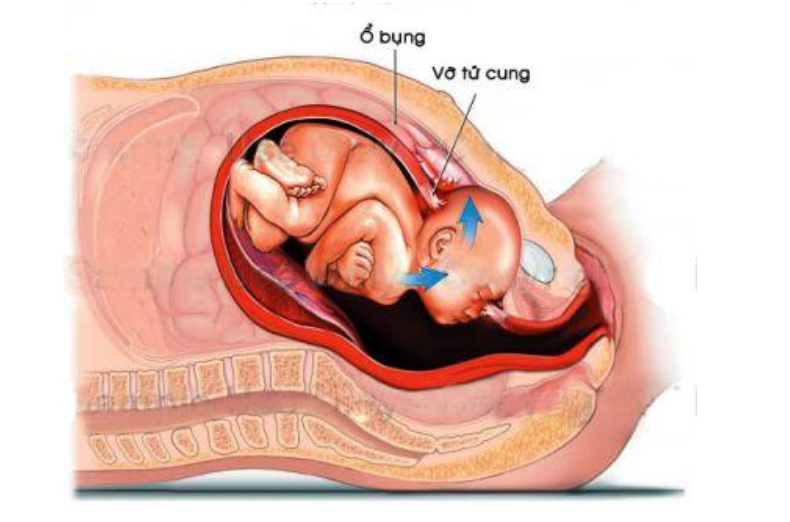 Sản phụ có nguy cơ vỡ tử cung khi đẻ thường lần 3