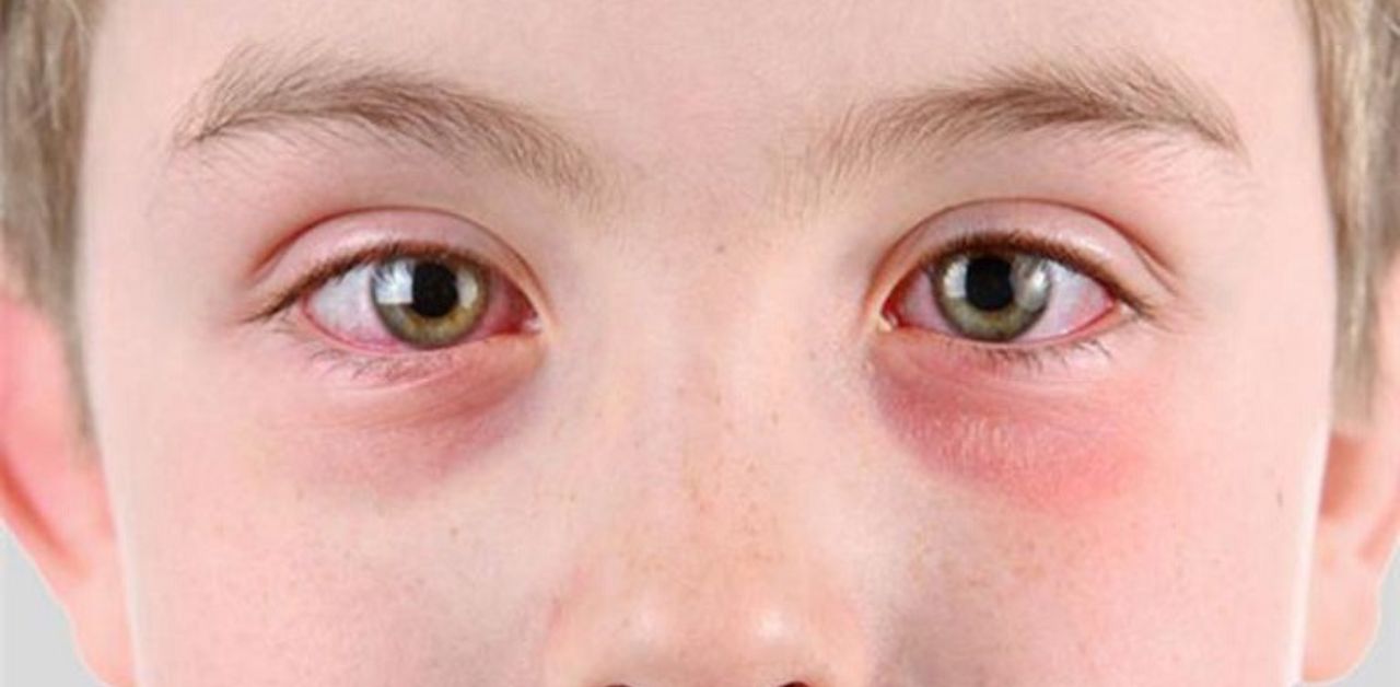 Mắt đỏ ở trẻ sơ sinh có liên quan đến nhiễm trùng không?
