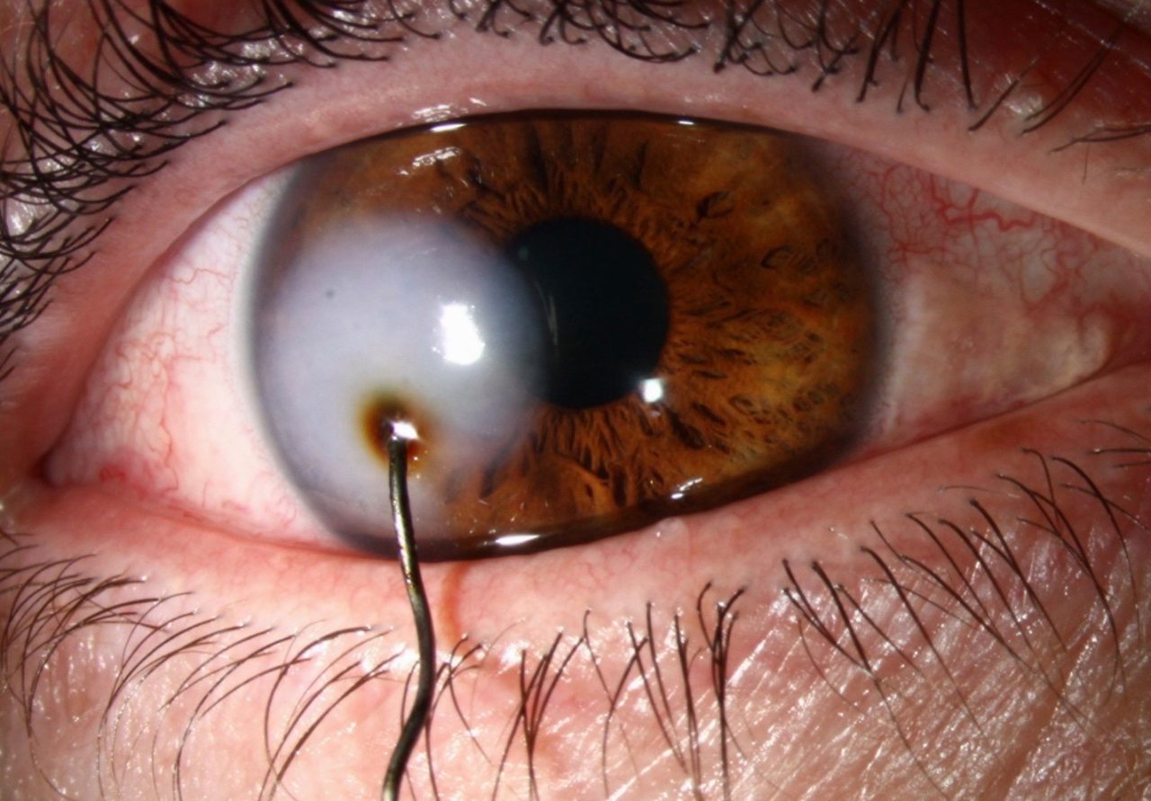  Mắt bị xước : Cách chăm sóc và khắc phục tình trạng trên mắt