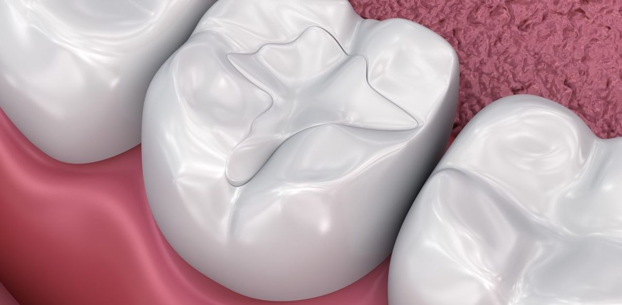 Những nguyên nhân gây ra cảm giác buốt sau khi hàn răng là gì?
