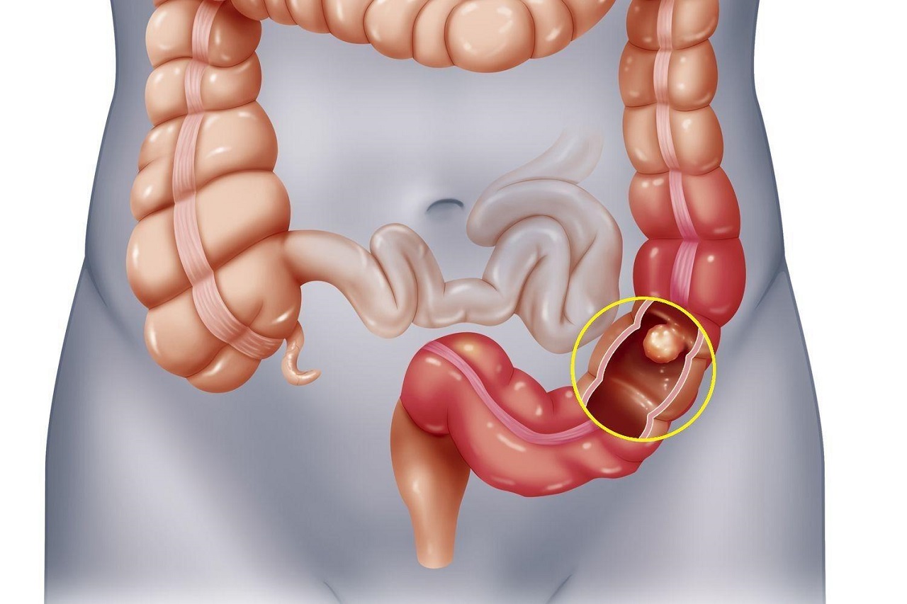 6. Tác động của đau ruột già đến cuộc sống