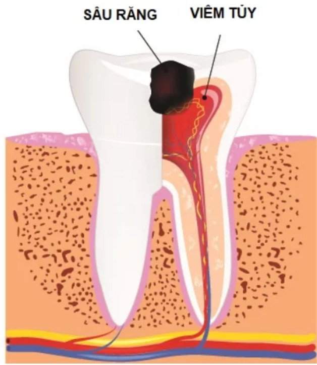 kỹ thuật điều trị tủy răng