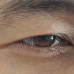 Mắt bị sụp mí có ảnh hưởng đến thị lực?