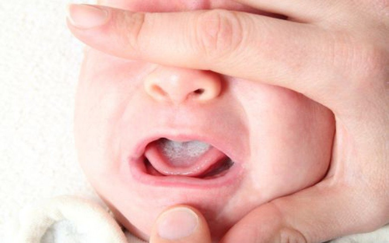 Mọi người đã từng bị nấm miệng ở trẻ sơ sinh bao lâu thì khỏi chưa