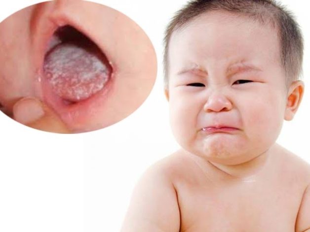 nấm miệng trẻ sơ sinh