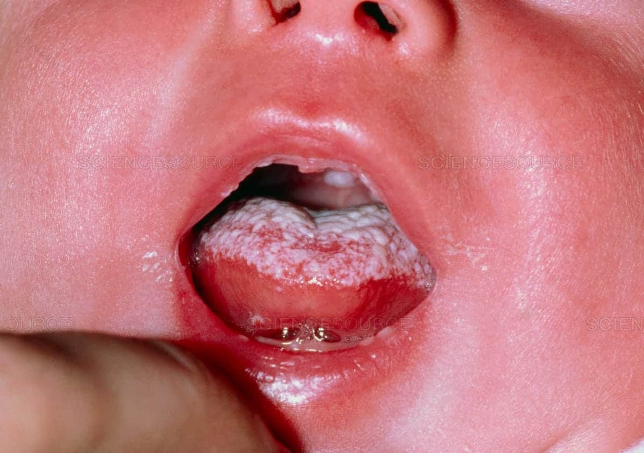 Loại nấm Candida albicans tồn tại ở vùng nào trong miệng của trẻ?
