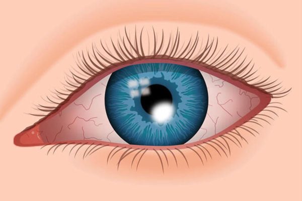 Sưng đỏ vùng mắt và thường xuyên chảy nước mắt là dấu hiệu mắc viêm loét giác mạc