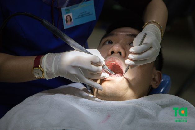 Lấy cao răng với chuyên gia để điều trị viêm lợi cục bộ